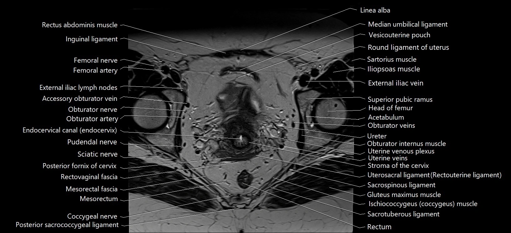 Axial cross sectional anatomy of female pelvis (MRI 3T) image 24.webp